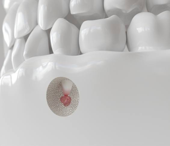 Illustrated model of jaw showing infection in tooth root