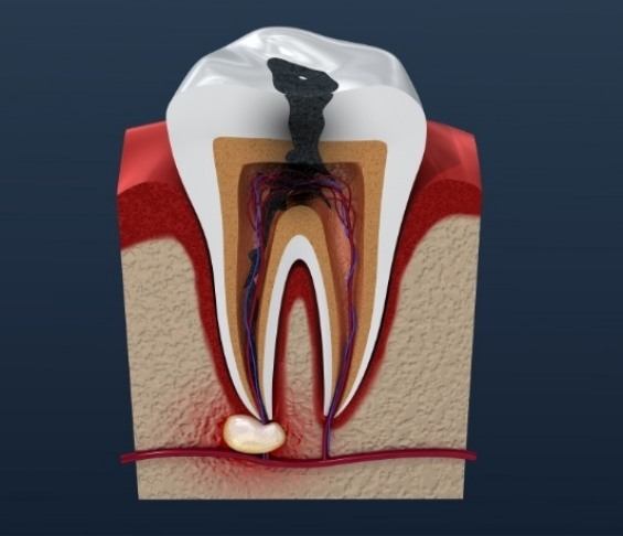 Illustrated tooth with dark spot in the root