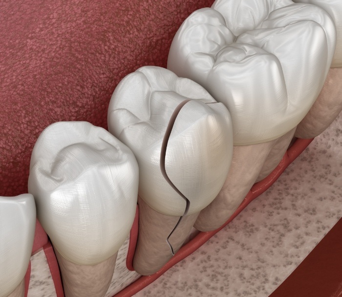 Close up illustration of a cracked tooth