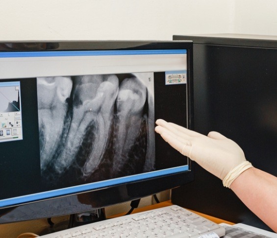 Gloved hand gesturing to computer monitor showing digital X rays of teeth